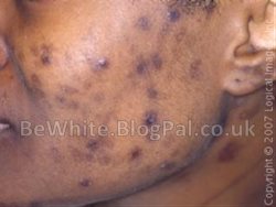 Skin bleach products for black skin