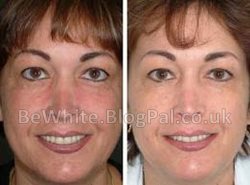 The best whitening cream for Somalian women
