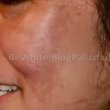 Whitening facial for Malawi people