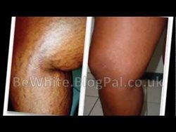 Best skin bleach for Jamaican people