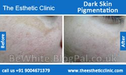 Best body whitening cream for Zambia people