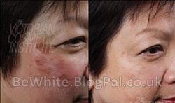 Natural skin whitening cream for Somalian people