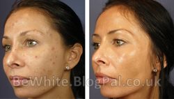 Whitening creams for Asian women