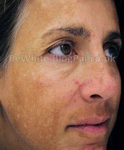 Skin lighteners for Black Trinidadians women