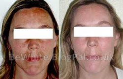 The best skin lightening cream for Congolese