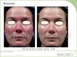 Natural skin bleaching for Congo people