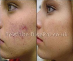 Brighten skin for Filipino