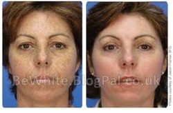 Skin whitening natural for Zambia people