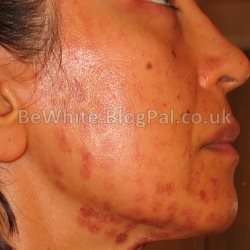 Most effective whitening cream for Filipino woman