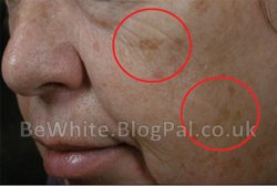 Kojic acid products for Malawi women