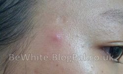 Skin whitening treatment for Africans woman