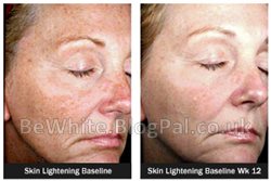 Revitol skin brightener for Trinidadians people