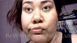 Pigmentation treatment for Asian people