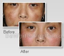 Skin treatments for Somali men