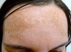 Dark spots remover creams for Africans men