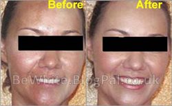 Pigmentation treatment for Trinidadians woman