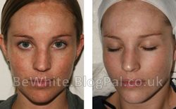Best whitening cream in the world for Congo woman