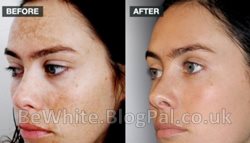 Skin whitening treatment for Bangladeshi