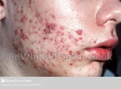 Acne creams for Black women