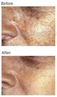 Skin bleach products for Malawian woman