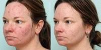 Bleaching body creams for Black Africans women