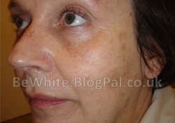 Bleaching skin for Somalia women