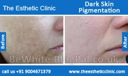 Skin whitening body cream for Black Trinidadians people