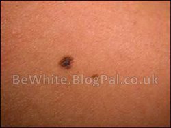 Bleaching dark skin cream for Indian people
