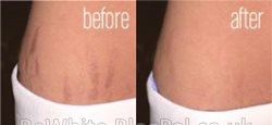Lightening neck creams for Indian men
