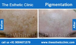 Bleaching skin products for Zimbabwean woman