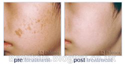 Natural skin lightening products for Zimbabwean people