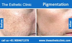 Hyperpigmentation cream for Nigerian men