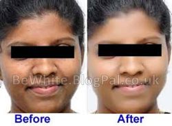 Best bleaching creams for Filipino people