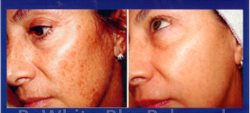 Hyperpigmentation creams for Black