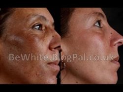 Effective skin whitening cream for Somalia women