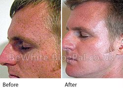 Natural skin whitener for Africans people