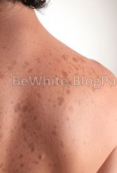 Asian skin whitening for Congo people