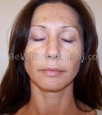 Whitening dark skin cream for Zimbabwean woman