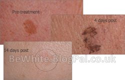 Facial whitening for Asian people