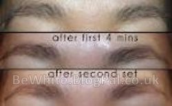 Bleaching cream with hydroquinone for Filipino people