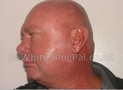 Facial whitening for Uganda woman