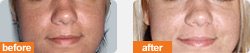 Kojic acid cream for Trinidadians men