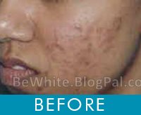 Bleaching skin for South African woman