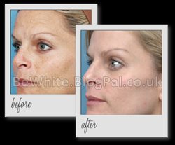 Natural skin lightening cream for Filipino