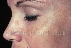 Uneven skin tone creams for Malawi