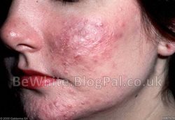 Body whitening cream for Malaysian women