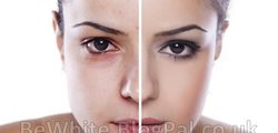 Skin lightening treatments for dark skin