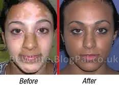 Bleaching skin cream for Zimbabwean woman