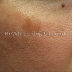 Skin treatment for Black woman
