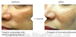Bleaching black skin cream for Malaysian people